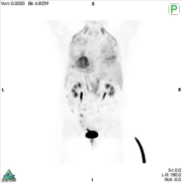 File:Non-Hodgkin lymphoma involving seminal vesicles with development of interstitial pneumonitis during Rituximab therapy (Radiopaedia 32703-33761 PET cor 3D MIP 7).jpg