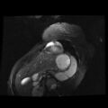 Non-compaction of the left ventricle (Radiopaedia 38868-41062 D 3).jpg