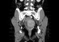 Non-puerperal uterine inversion (Radiopaedia 78343-91094 B 44).jpg