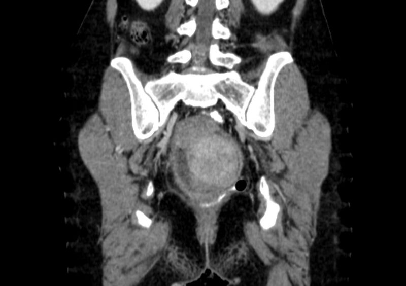 File:Non-puerperal uterine inversion (Radiopaedia 78343-91094 B 44).jpg