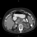 Non Hodgkin lymphoma in a patient with ankylosing spondylitis (Radiopaedia 84323-99624 Axial non-contrast 38).jpg