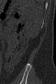 Normal CT lumbar spine (Radiopaedia 53981-60118 Sagittal bone window 107).jpg