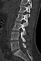 Normal CT lumbar spine (Radiopaedia 53981-60118 Sagittal bone window 40).jpg