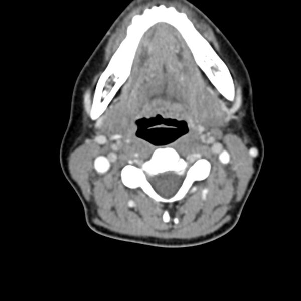 File:Normal CT of the neck (Radiopaedia 14575-14500 Axial C+ 34).jpg