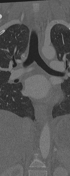 File:Normal CT thoracic spine (Radiopaedia 40181-42688 Coronal bone window 16).png