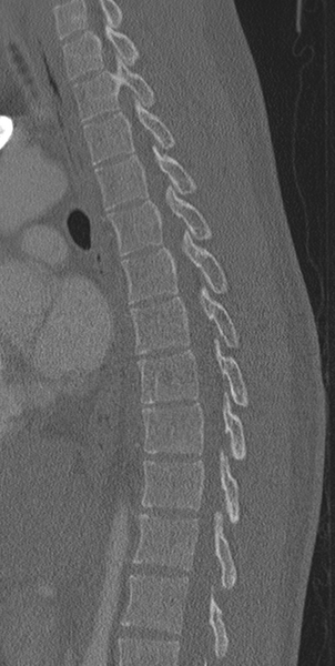 File:Normal CT thoracic spine (Radiopaedia 40181-42688 Sagittal bone window 30).png