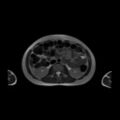 Normal MRI abdomen in pregnancy (Radiopaedia 88001-104541 Axial T2 29).jpg