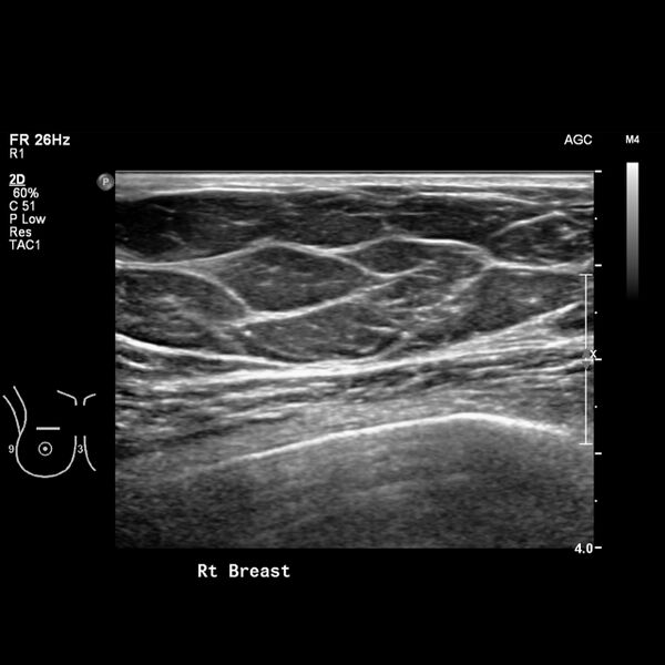 File:Normal breast mammography (tomosynthesis) and ultrasound (Radiopaedia 65325-74354 Right breast 2).jpeg
