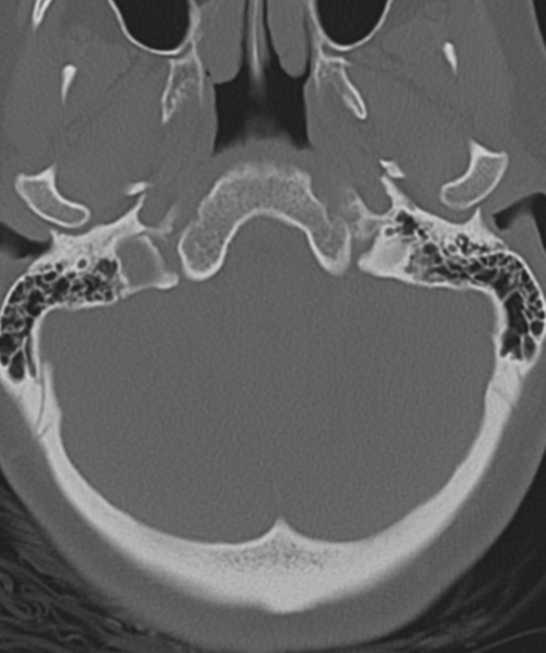 File:Normal cervical spine MRI (including Dixon) (Radiopaedia 42762-45926 Axial bone window 3).png