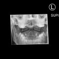 Normal cervical spine trauma radiographs (age 14) (Radiopaedia 45337-49360 PEG view 1).jpg