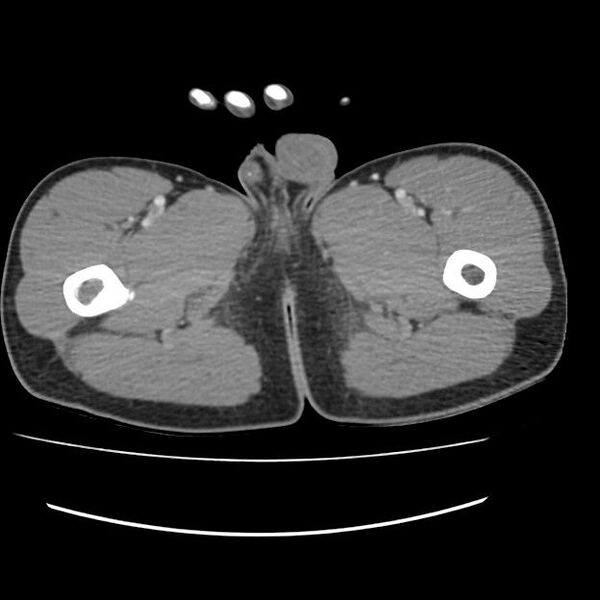 File:Normal dual-phase trauma CT chest,abdomen and pelvis (Radiopaedia 48092-52899 A 125).jpg
