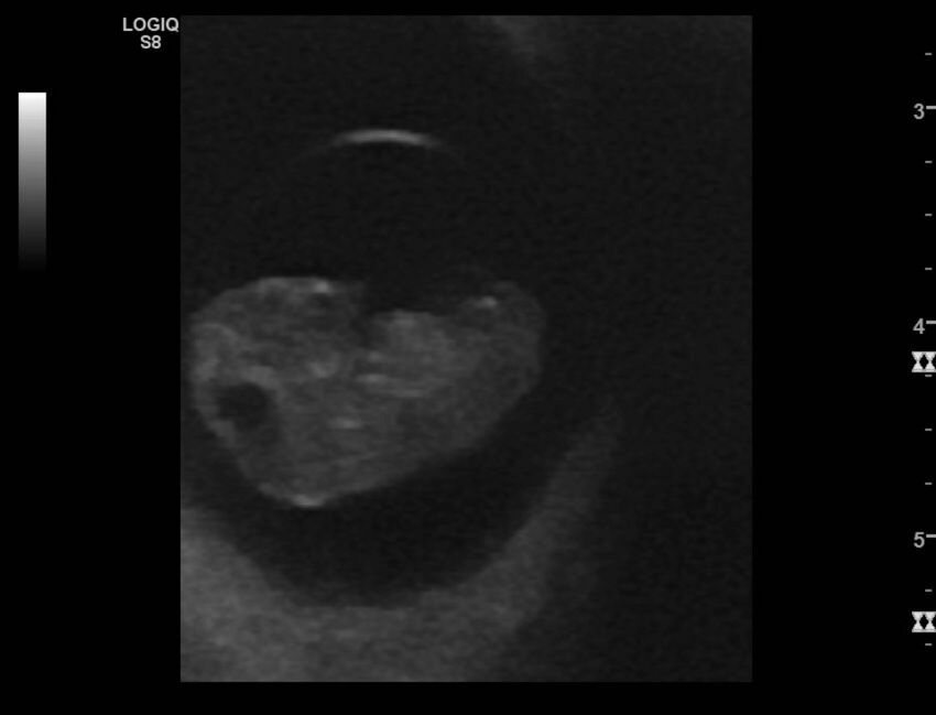 Normal early pregnancy - 8w0d (Radiopaedia 44715-48492 Longitudinal 28).jpg