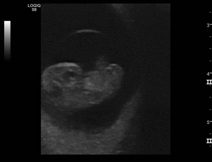 Normal early pregnancy - 8w0d (Radiopaedia 44715-48492 Longitudinal 33).jpg