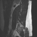 Normal lumbar spine MRI (Radiopaedia 47857-52609 Sagittal T2 21).jpg
