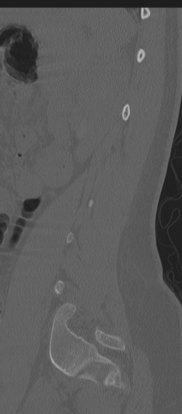 File:Normal lumbosacral CT (Radiopaedia 37923-39867 Sagittal bone window 21).png