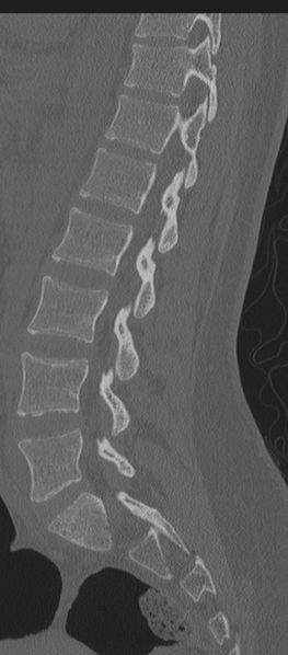 File:Normal lumbosacral CT (Radiopaedia 37923-39867 Sagittal bone window 42).png