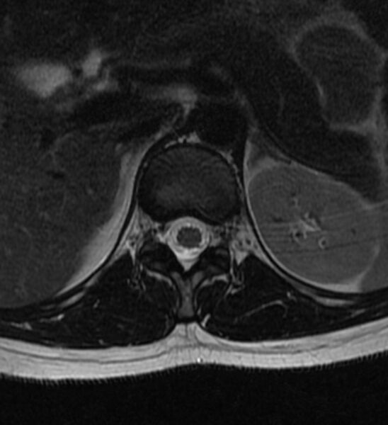 File:Normal thoracic spine MRI (Radiopaedia 41033-43781 Axial T2 26).jpg