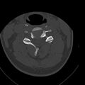 Occipital condyle fracture (Radiopaedia 31755-32691 Axial bone window 36).jpg