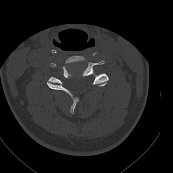 File:Occipital condyle fracture (Radiopaedia 31755-32691 Axial bone window 36).jpg