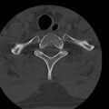 Occipital condyle fracture (Radiopaedia 31755-32691 Axial bone window 77).jpg