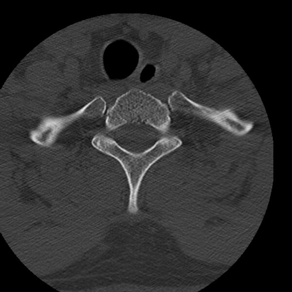 File:Occipital condyle fracture (Radiopaedia 31755-32691 Axial bone window 77).jpg