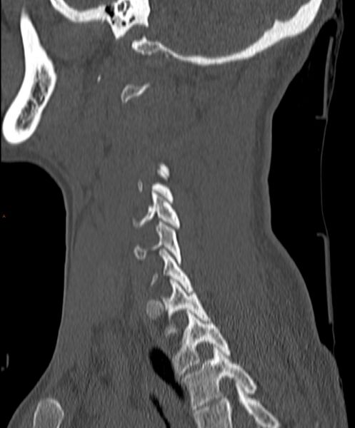 File:Occipital condyle fracture (Radiopaedia 61165-69056 Sagittal bone window 19).jpg