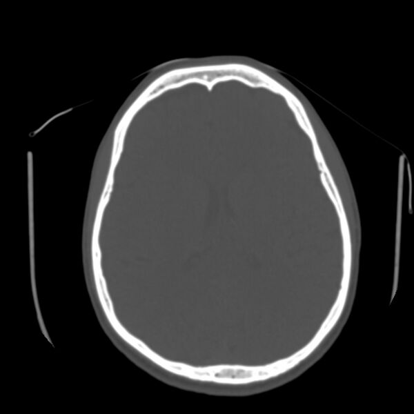 File:Occipital spur - asymptomatic (Radiopaedia 87753-104201 Axial bone window 119).jpg
