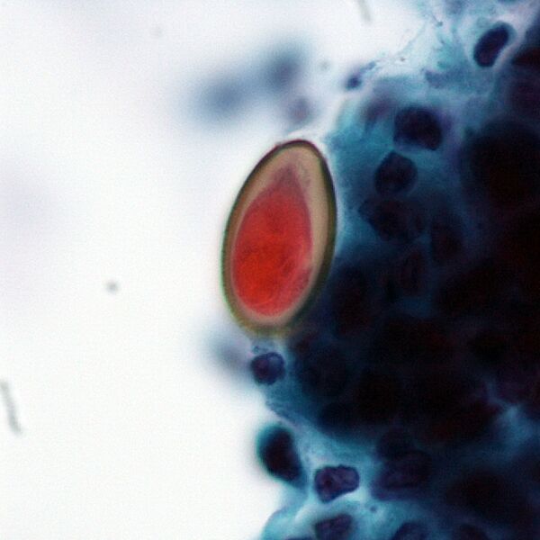 File:Opisthorchis sinensis liver fluke egg (photo) (Radiopaedia 36415).jpg