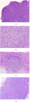a,b,c,d)Representative histologic images of the follicular lymphoma