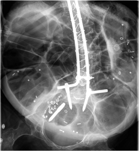 Radiograph of abdomen, of individual with Duchenne muscular dystrophy, spine stabilization is achived via rods and screws (one is displaced) and a Percutaneous endoscopic gastrostomy is visible