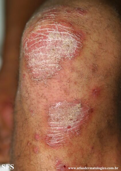File:Psoriasis (Dermatology Atlas 130).jpg