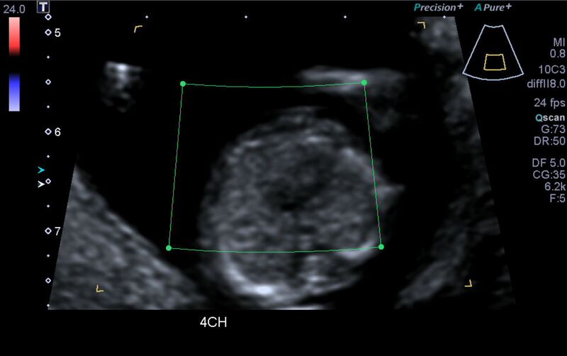 File:1st trimester nuchal-morphology ultrasound (Radiopaedia 44706-48477 Heart views cine with colour 46).jpg