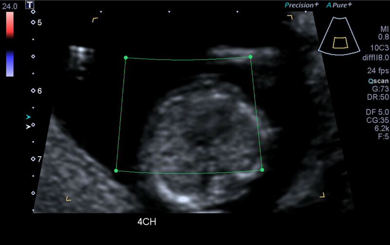 File:1st trimester nuchal-morphology ultrasound (Radiopaedia 44706-48477 Heart views cine with colour 65).jpg