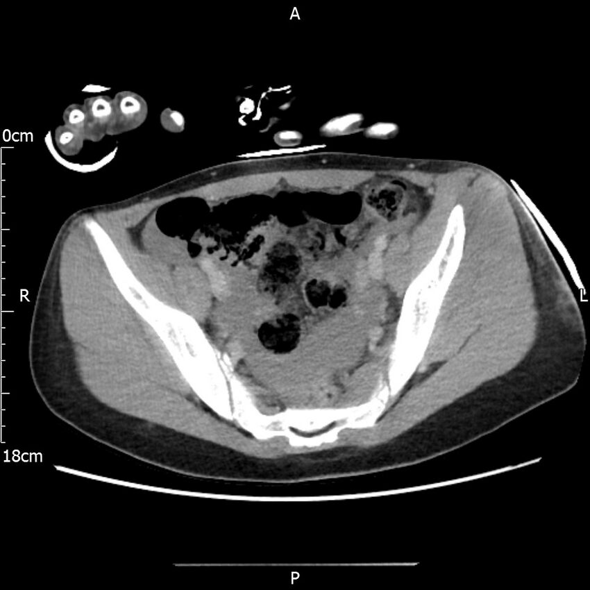 AAST grade IV kidney injury with CEUS follow-up (Radiopaedia 72353-82877 Axial C+ portal venous phase 62).jpg