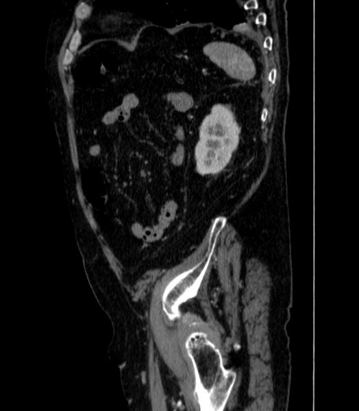 File:Abdominal aortic aneurysm (Radiopaedia 25855-26001 Sagittal C+ arterial phase 71).jpg