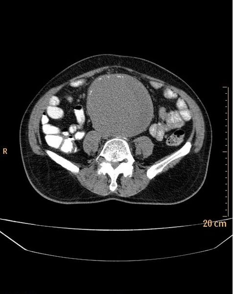File:Abdominal aortic aneurysm (Radiopaedia 25985-26121 Axial non-contrast 17).jpg