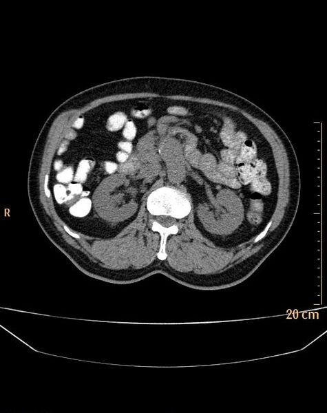 File:Abdominal aortic aneurysm (Radiopaedia 25985-26121 Axial non-contrast 6).jpg