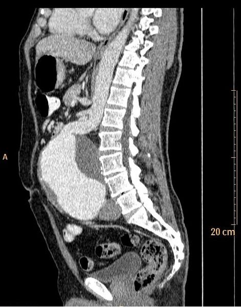 File:Abdominal aortic aneurysm (Radiopaedia 25985-26121 Sagittal C+ arterial phase 13).jpg