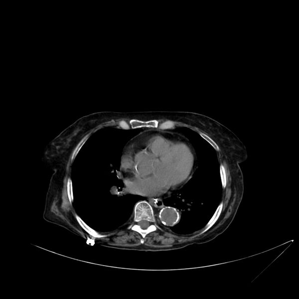 File:Abdominal aortic aneurysm - impending rupture (Radiopaedia 19233-19246 Axial non-contrast 3).jpg