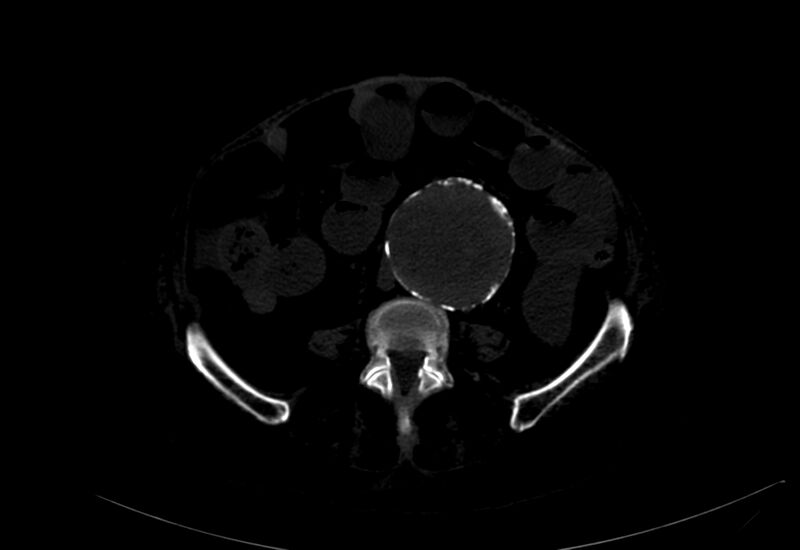 File:Abdominal aortic aneurysm - impending rupture (Radiopaedia 19233-19246 B 29).jpg