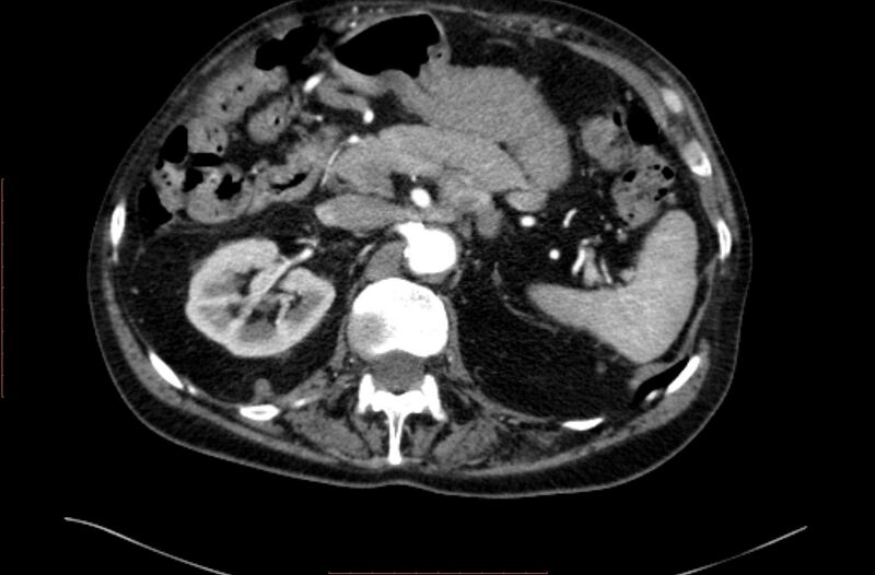 File:Abdominal aortic interposition tube graft and aneurysm thrombosis (Radiopaedia 71438-81857 Axial C+ arterial phase 30).jpg