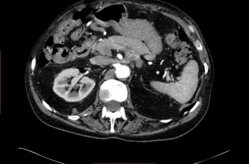 Abdominal aortic interposition tube graft and aneurysm thrombosis (Radiopaedia 71438-81857 Axial C+ arterial phase 30).jpg