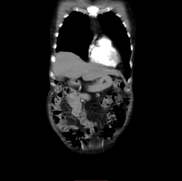 File:Abdominal aortic interposition tube graft and aneurysm thrombosis (Radiopaedia 71438-81857 Coronal C+ arterial phase 6).jpg
