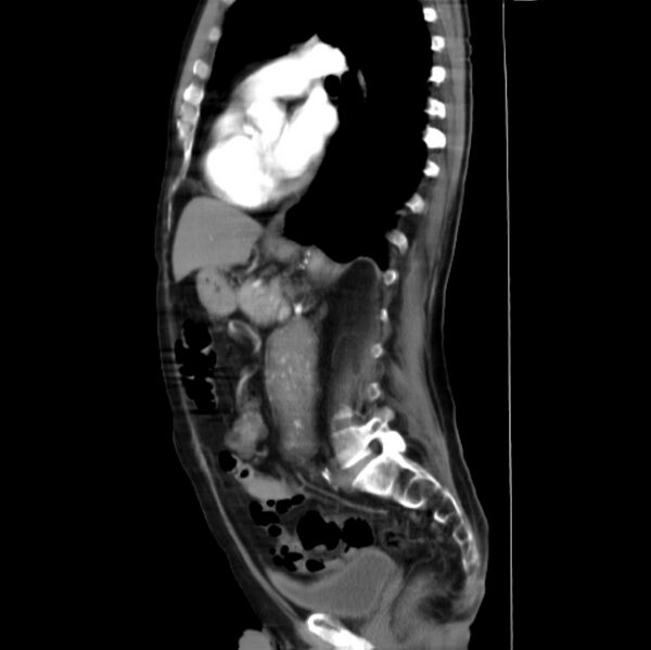 File:Abdominal aortic interposition tube graft and aneurysm thrombosis (Radiopaedia 71438-81857 Curved Sagittal C+ arterial phase 2).jpg