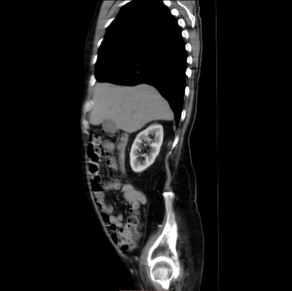 File:Abdominal aortic interposition tube graft and aneurysm thrombosis (Radiopaedia 71438-81857 Sagittal C+ arterial phase 26).jpg
