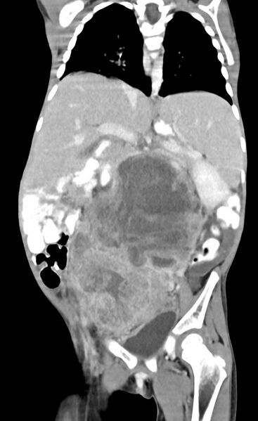 File:Abdominopelvic rhabdomyosarcoma (Radiopaedia 78356-90984 Coronal C+ portal venous phase 54).jpg