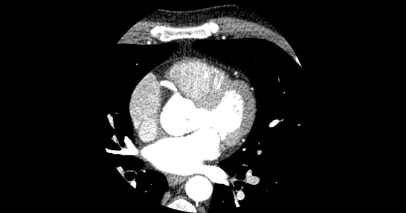 File:Aberrant left main coronary artery (ALMCA) arising from the right sinus with interarterial course (Radiopaedia 63251-71814 Axial C+ arterial phase 79).JPG