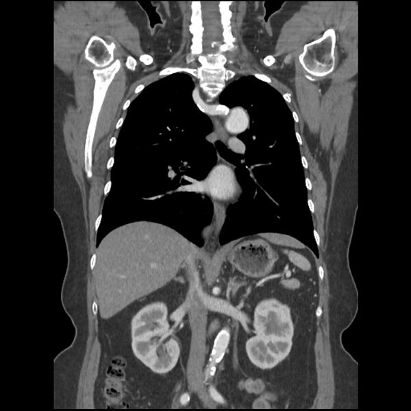 File:Aberrant right subclavian and left vertebral arteries (Radiopaedia 43467-46847 Coronal C+ portal venous phase 51).jpg