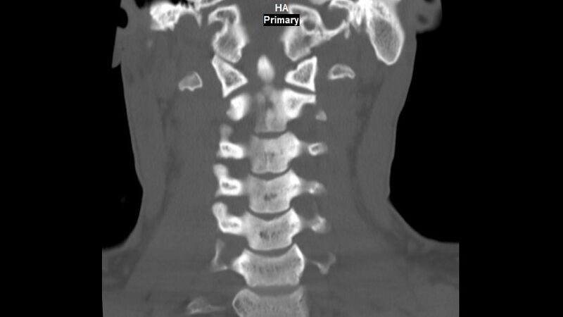 File:Accessory ossicle of the anterior arch of C1 vertebra (Radiopaedia 58149-65211 Coronal bone window 7).jpg