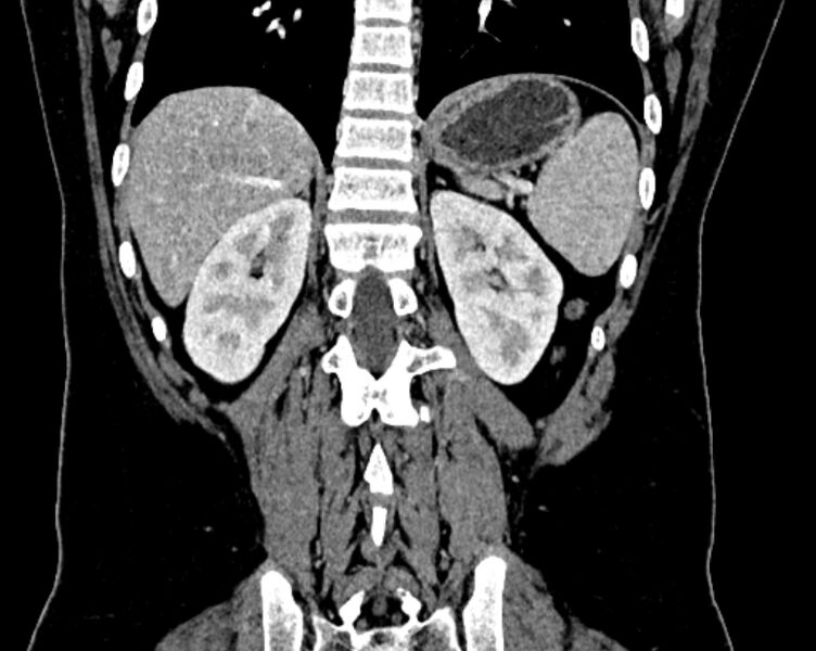 File:Accessory right inferior hepatic vein (Radiopaedia 75207-86305 Coronal C+ portal venous phase 58).jpg